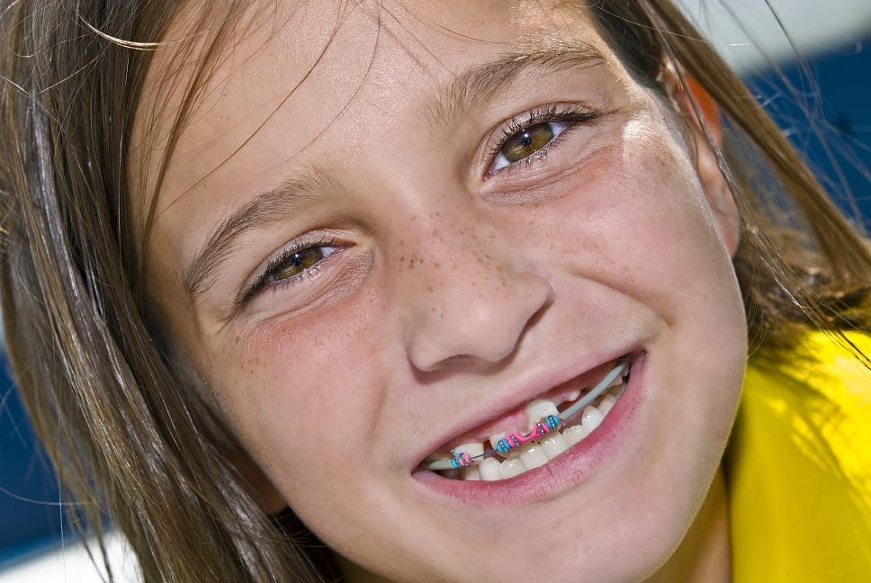 Cost of braces for kids deals