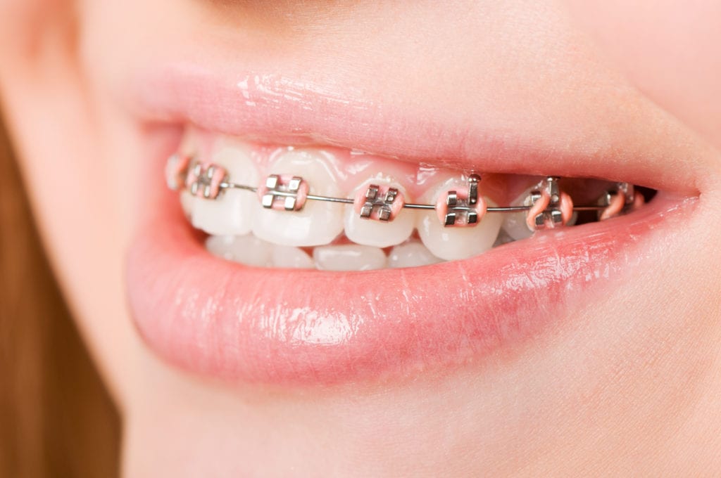 cheap braces queensland